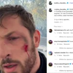 Mathis Chevalier : le combattant de MMA témoigne après sa blessure à l’œil